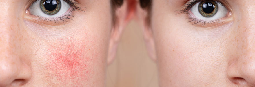 Traiter les dermatoses